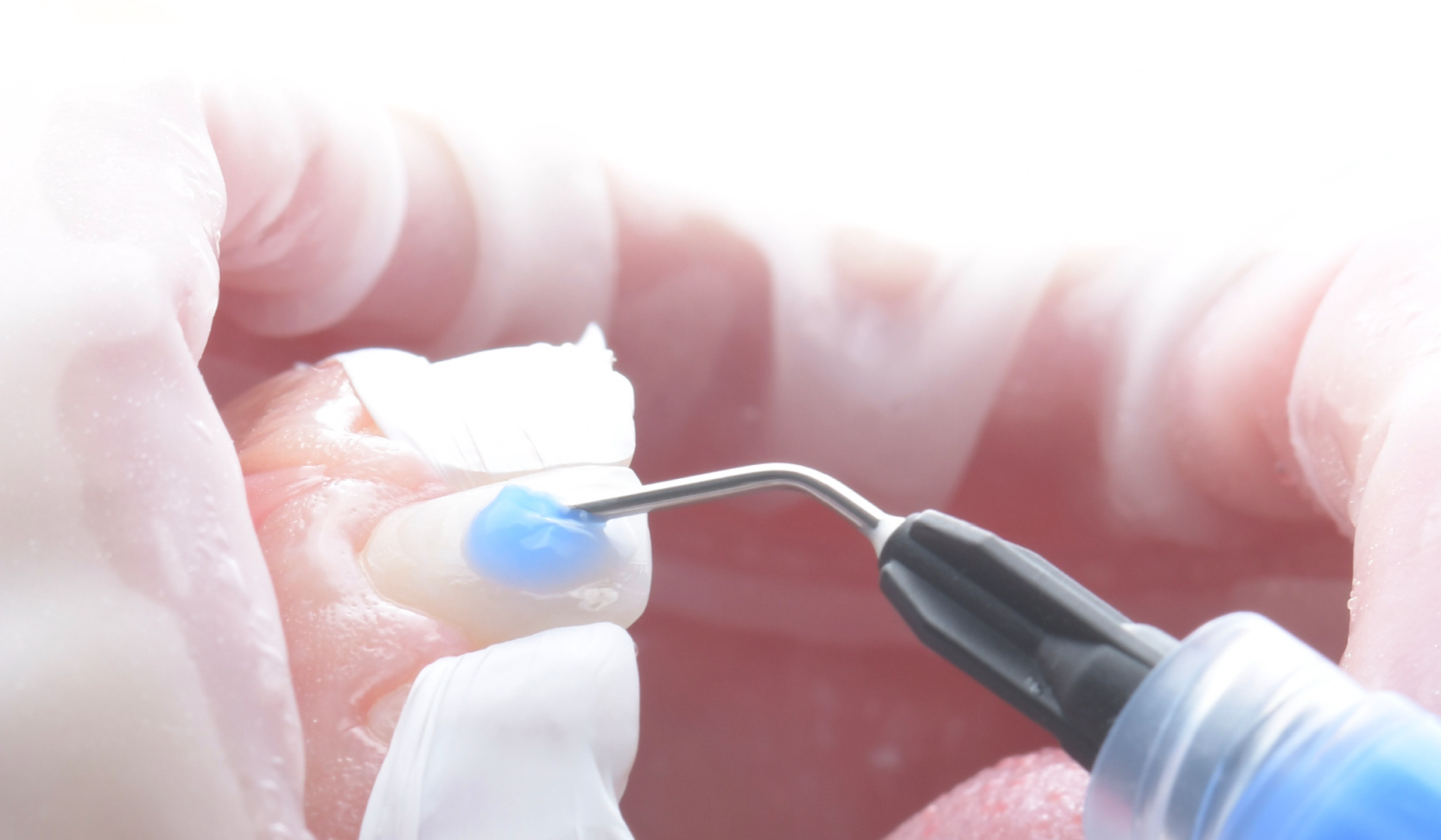 Figure 5a: Phosphoric acid etching. Adjacent teeth are protected with PTFE tape.